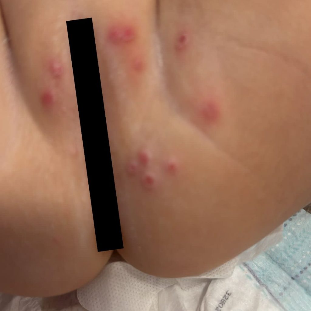 פריחת חיתולים, תפרחת חיתולים