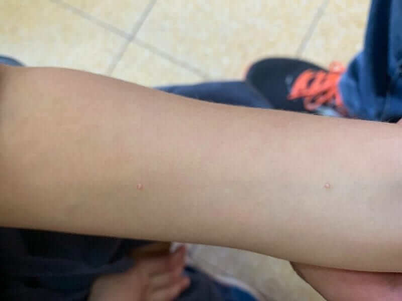 תמונה מספר 1 - נגע אופייני