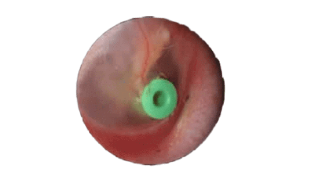 דלקת אוזניים עם תפליט (נוזלים באוזניים)