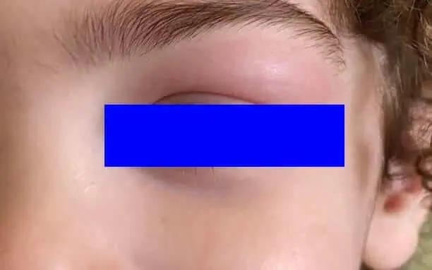 עקיצות בילדים (בעיקר יתושים, קצת חרקים, מעט דבורים) - דוקטור אפי