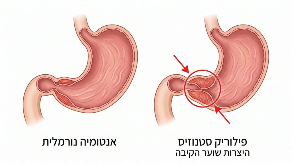 פילוריק סטנוזיס