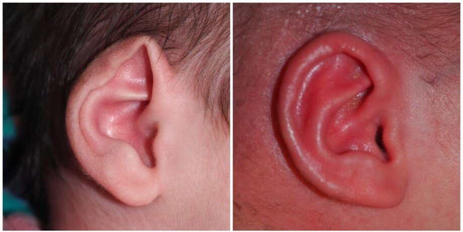 עיוותי אוזניים בתינוקות