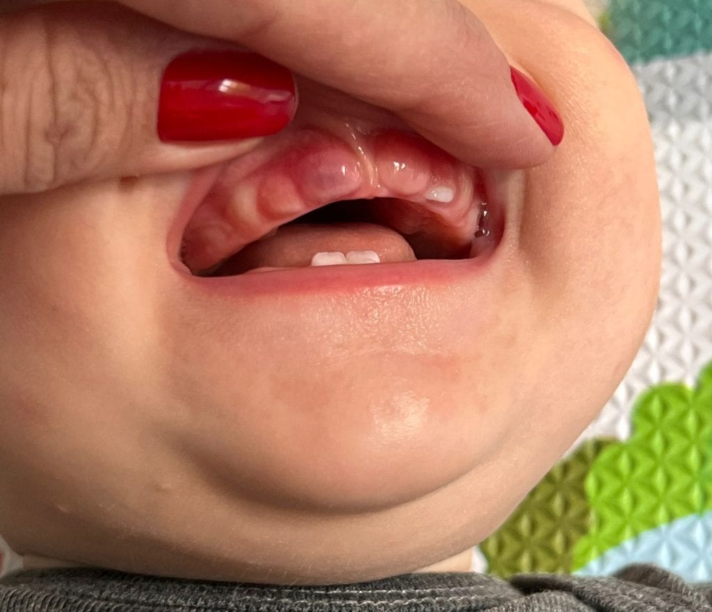 ציסטת בקיעה eruption cyst