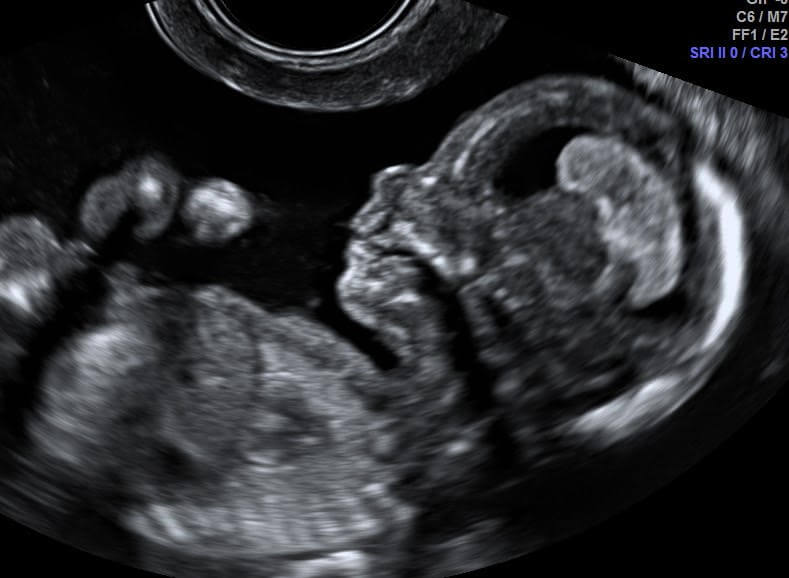 בדיקות אולטרסאונד וסקירת מערכות עובר בהריון