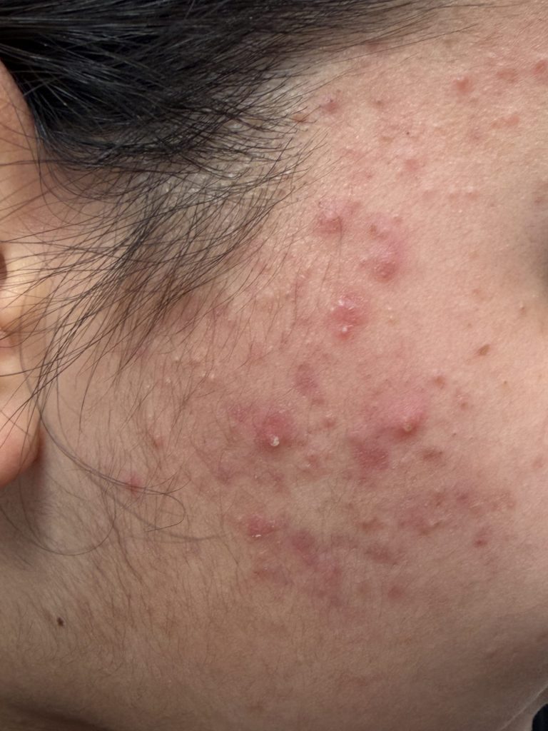 אקנה (פצעי בגרות) - כל מה שרציתם לדעת - דוקטור אפי