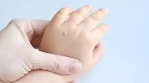 יבלת טיפוסית