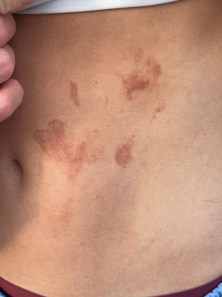 פיטו פוטו דרמטיטיס