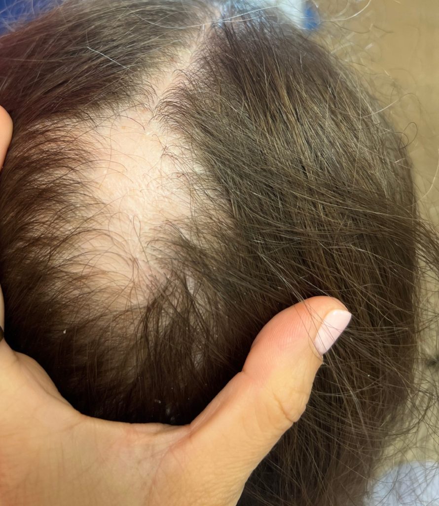 אלופציה אראטה בילדים - דוקטור אפי