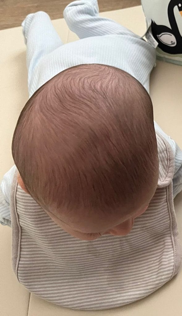 פלגיוצפליה טורטיקוליס
