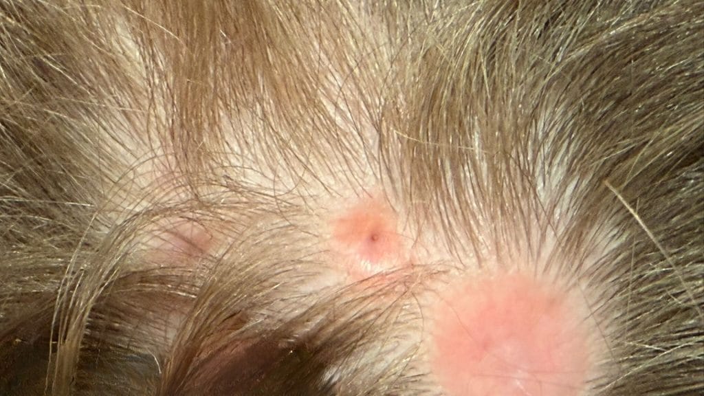 קוטיס אפלסיה (Aplasia Cutis Congenita) היא תופעה נדירה שבה תינוק נולד עם אזור חסר עור. מדובר במום מולד שמופיע לרוב בקרקפת, אך עשוי להופיע גם בגפיים, בבטן או בגב. ברוב המקרים הפגם קטן ושטחי, אך לעיתים הוא עמוק יותר וכולל גם פגיעה ברקמות שמתחת לעור, ואף בעצם. למרות המראה החריג, ברוב המקרים מדובר במצב שאינו מסכן חיים וניתן לטיפול מוצלח.