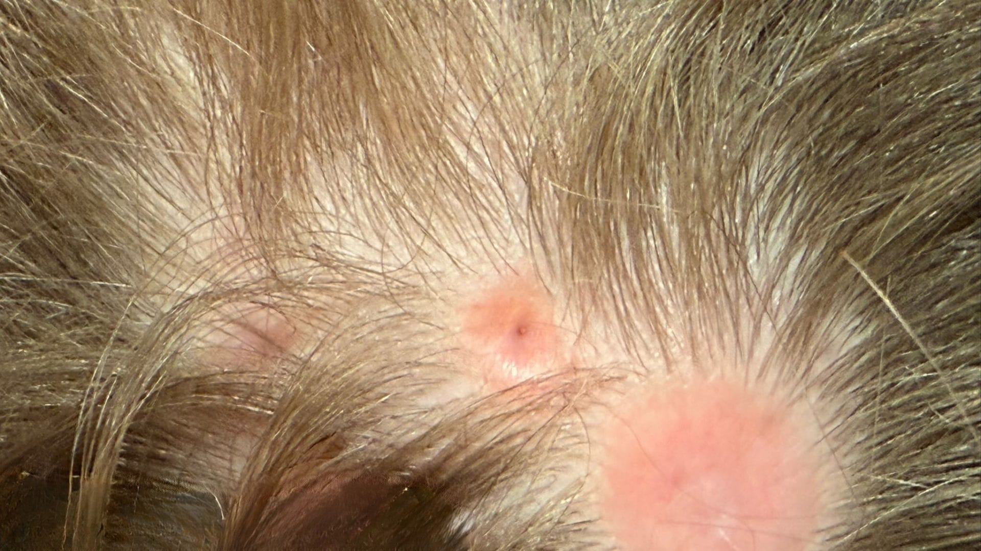 קוטיס אפלסיה (Aplasia Cutis Congenita) היא תופעה נדירה שבה תינוק נולד עם אזור חסר עור. מדובר במום מולד שמופיע לרוב בקרקפת, אך עשוי להופיע גם בגפיים, בבטן או בגב. ברוב המקרים הפגם קטן ושטחי, אך לעיתים הוא עמוק יותר וכולל גם פגיעה ברקמות שמתחת לעור, ואף בעצם. למרות המראה החריג, ברוב המקרים מדובר במצב שאינו מסכן חיים וניתן לטיפול מוצלח.
