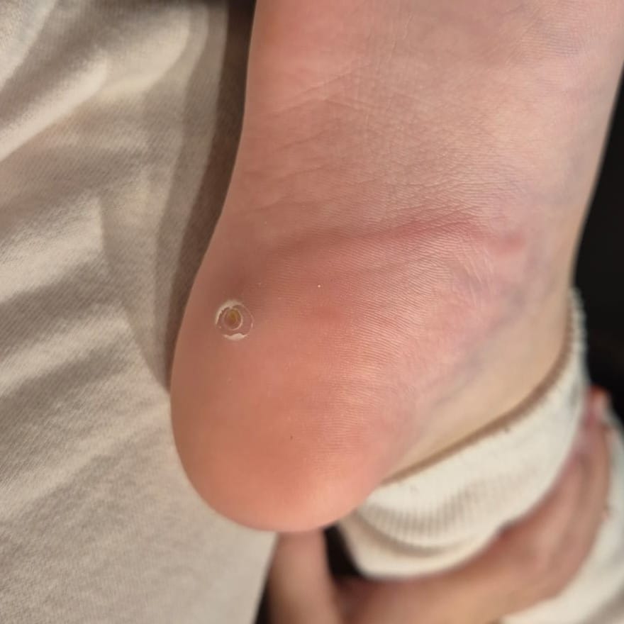 לימפאנגיטיס