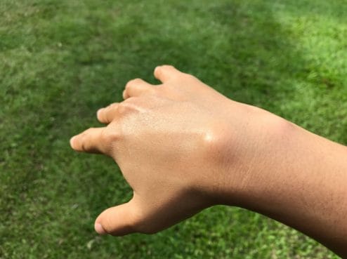 ציסטה גנגליונית ביד (גנגליון)