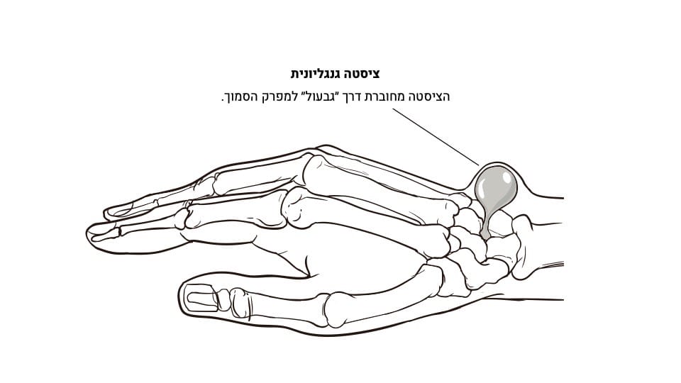ציסטה דוגמה שלישית
