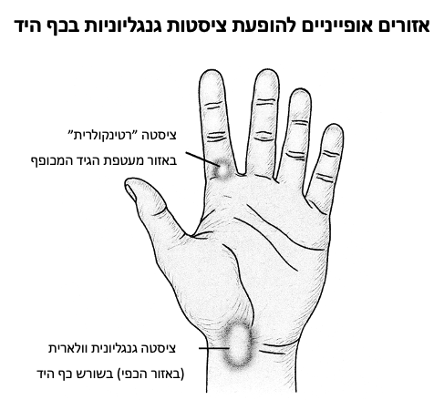דוגמה לציסטה גנגליונית נוספת