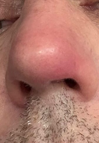 הרפס על האף 2