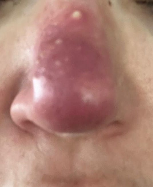 הרפס על האף - התייצגות שונה שאסור לפספס