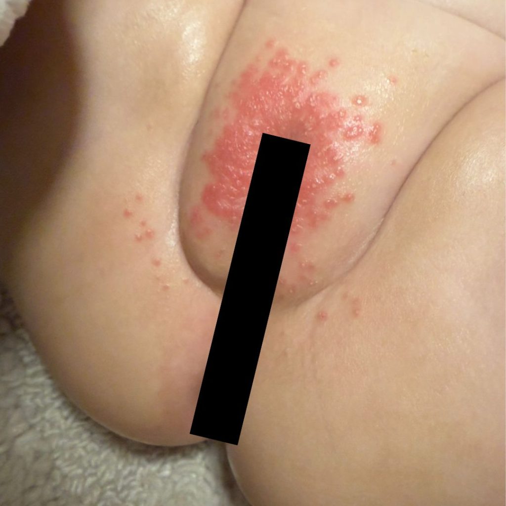 הכול על פריחת חיתולים בתינוקות - אבחון וטיפול