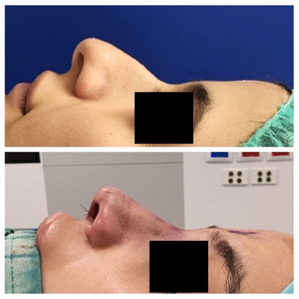 ניתוחי אף בבני נוער ומבוגרים