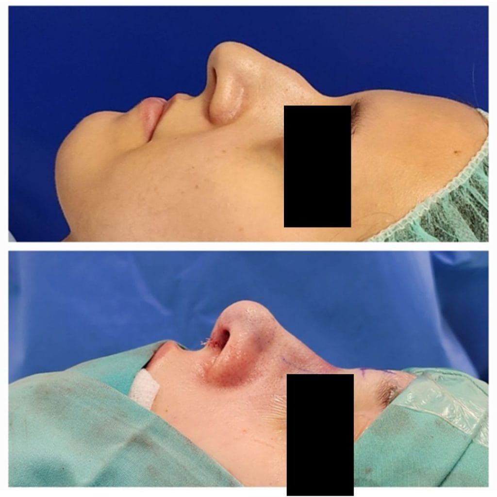 ניתוחי אף בבני נוער ומבוגרים