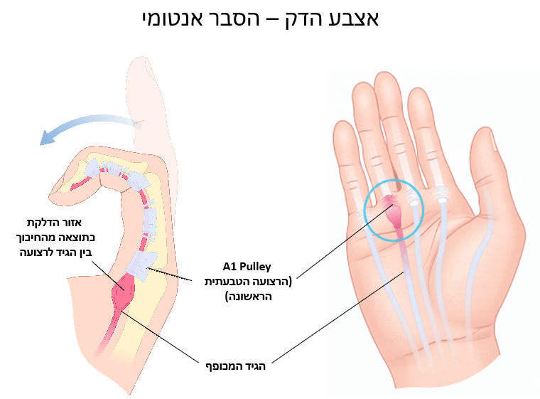 אצבע הדק (Trigger Finger) בילדים ומבוגרים