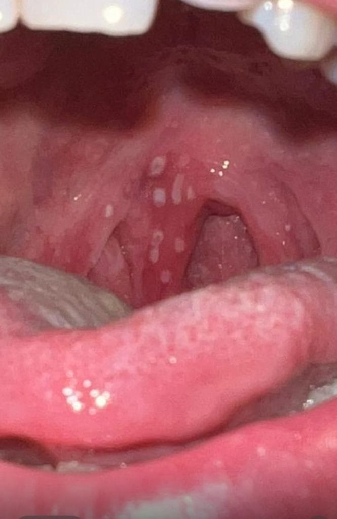 דלקת גרון מהרפס בילדים ובמבוגרים - התייצגות יוצאת דופן שאסור לפספס