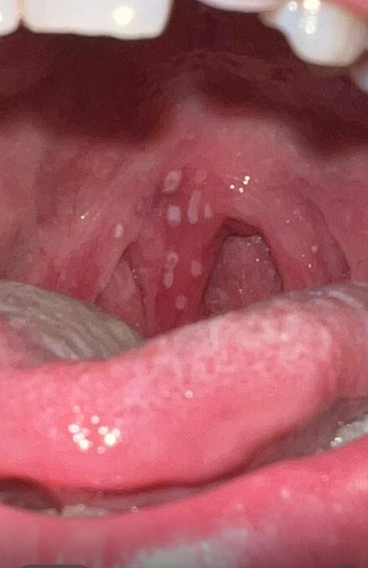 דלקת גרון מהרפס בילדים ובמבוגרים - התייצגות יוצאת דופן שאסור לפספס