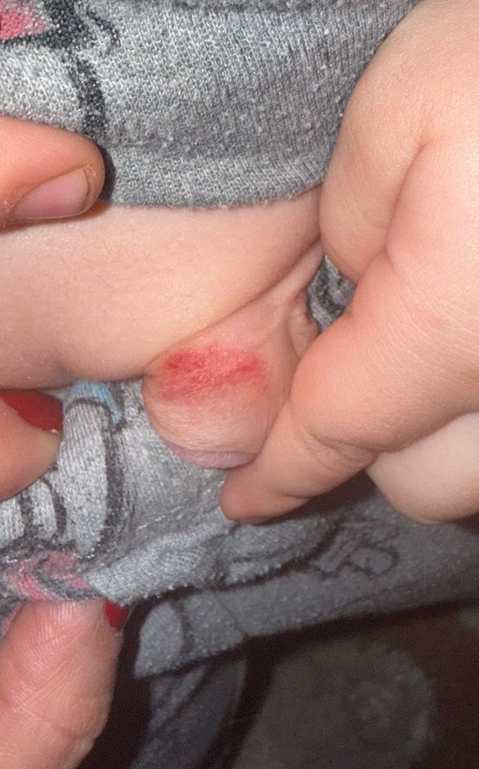 חבלה לפין בילדים ממכסה אסלה - תסמונת טריסטרם שנדי