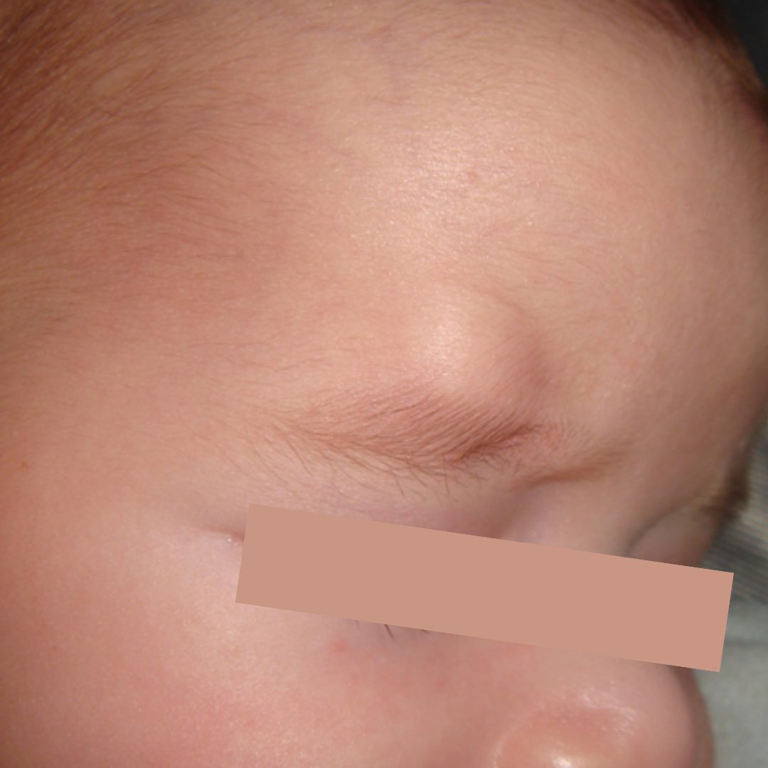 ציסטה דרמואידית בילדים – מה זה ומה עושים?