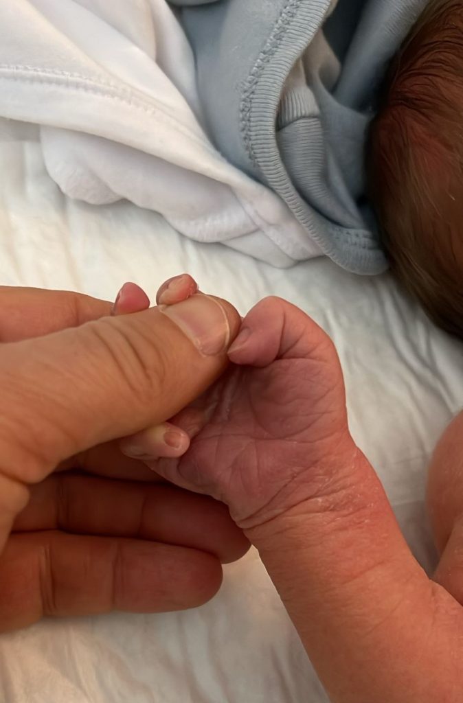 אקרוציאנוזיס תמונה שנייה