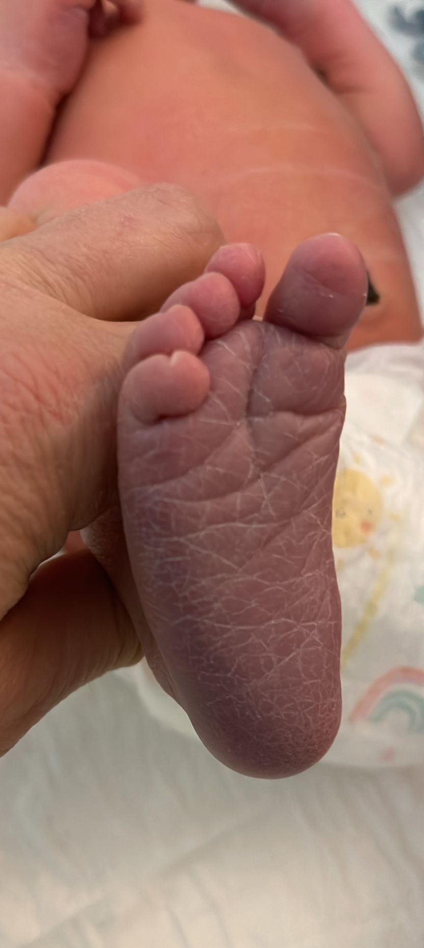 אקרוציאנוזיס בילוד - כפות ידיים ורגליים כחולות