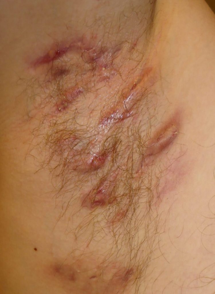 הידראדניטיס סופורוטיבה – מחלת עור כרונית שחשוב להכיר