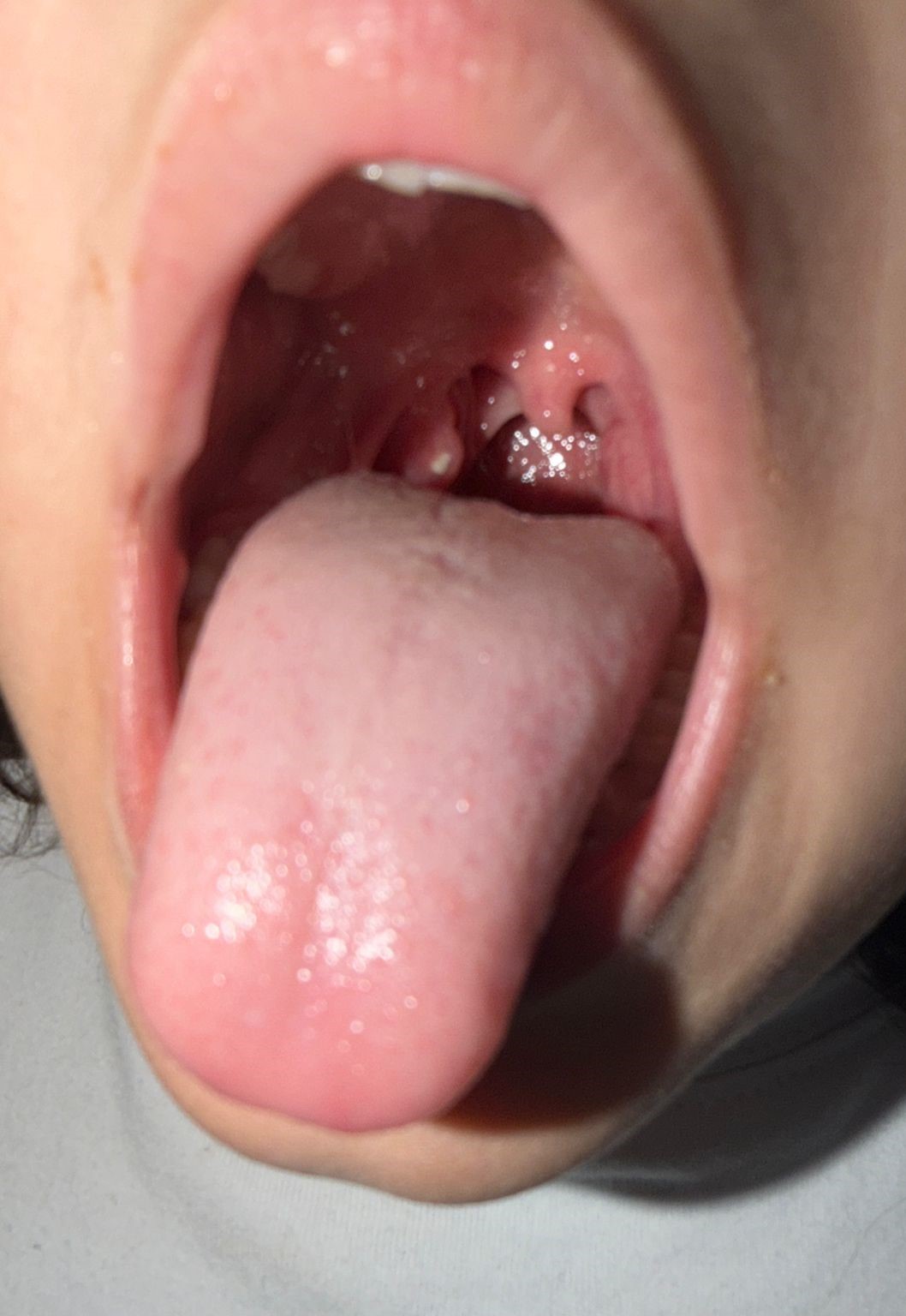 זה לא תפליטים בגרון - בצק או סידן על השקדים