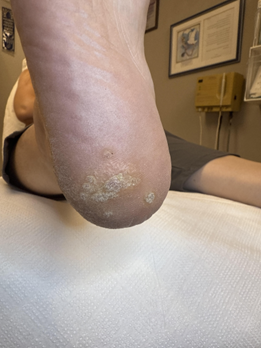 הקרב היום יומי של רגל החייל הישראלי – מיבלות וזיהומים ועד שברי מאמץ - דוקטור אפי