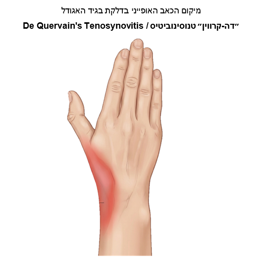 דלקת בגידים בשורש כף היד סביב האגודל - De Quervain’s Tenosynovitis (דה-קרווין טנוסינוביטיס או ״כאב אגודל של אמהות״)