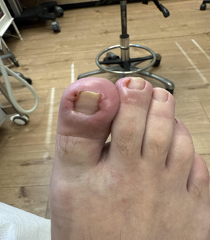 הקרב היום יומי של רגל החייל הישראלי – מיבלות וזיהומים ועד שברי מאמץ - דוקטור אפי