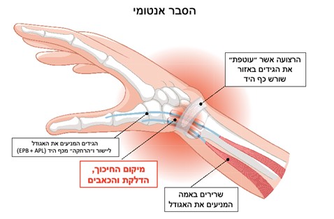 דלקת בגידים בשורש כף היד סביב האגודל - De Quervain’s Tenosynovitis (דה-קרווין טנוסינוביטיס או ״כאב אגודל של אמהות״)
