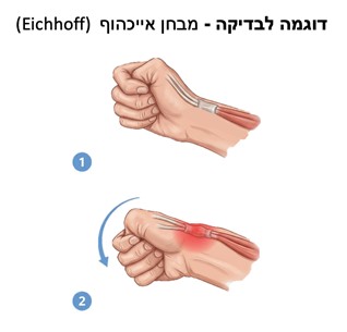 דלקת בגידים בשורש כף היד סביב האגודל - De Quervain’s Tenosynovitis (דה-קרווין טנוסינוביטיס או ״כאב אגודל של אמהות״)
