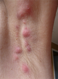 הידראדניטיס סופורוטיבה – מחלת עור כרונית שחשוב להכיר