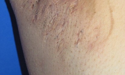 הידראדניטיס סופורוטיבה – מחלת עור כרונית שחשוב להכיר