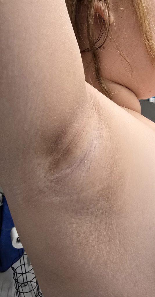 אקנתוזיס ניגריקנס – אזורים כהים על העור - סימן חשוב ביותר בילדים