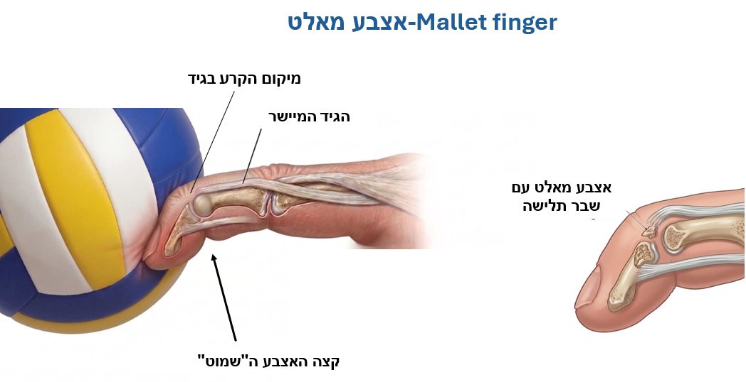פגיעות באצבעות הקשורות בספורט בילדים ובמבוגרים (אצבע כדורסל ואצבע סקי)