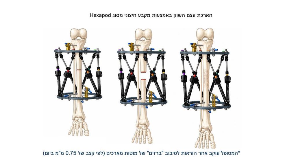 הכול על אי שוויון באורך הגפיים בילדים (רגל קצרה ורגל ארוכה) - דוקטור אפי