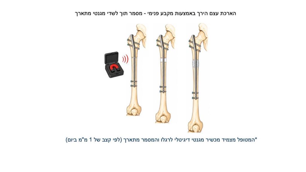 הכול על אי שוויון באורך הגפיים בילדים (רגל קצרה ורגל ארוכה) - דוקטור אפי