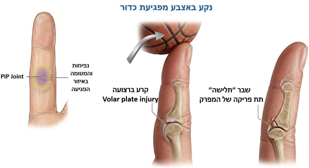 נקע באצבע מפגיעת כדור