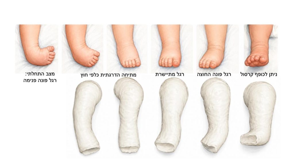 תמונה גבסים