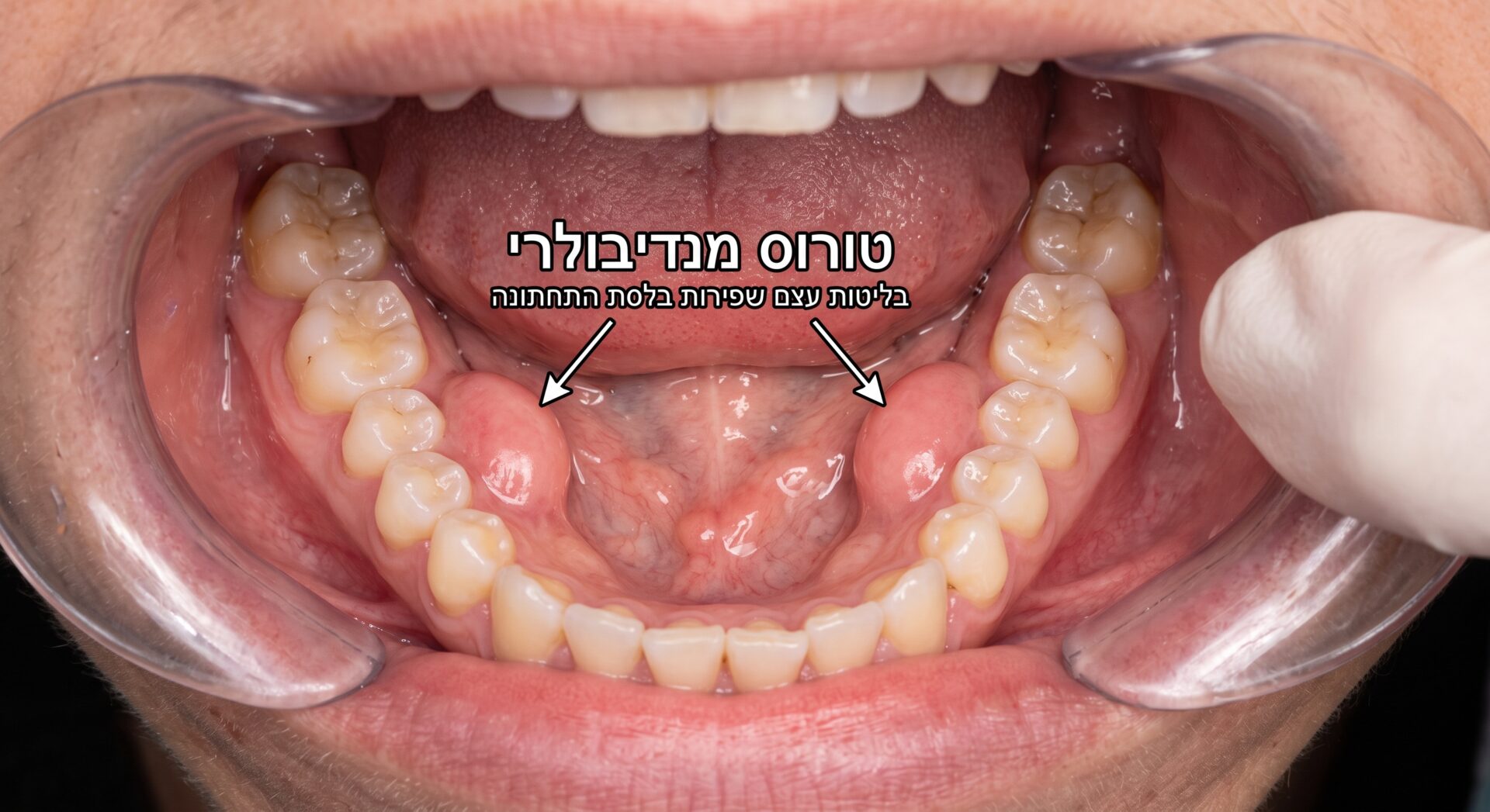 מצאתם בליטה קשיחה בפה? זה מה שאתם צריכים לדעת על טורוס מנדיבולרי